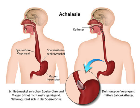 Achalasie, Erkrankung Vektor Illustration