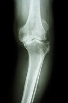 osteoarthritis knee patient