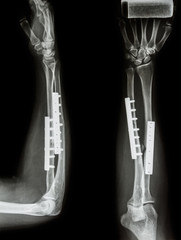fracture shaft of radius & ulnar bone. It was operated and inter