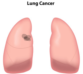 Lung Cancer