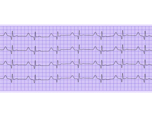 Heart analysis, electrocardiogram graph (ECG)