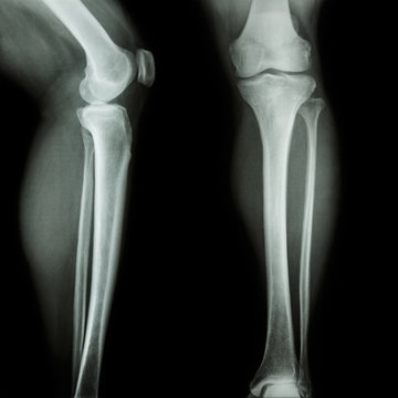 x-ray leg & knee AP(Anterior-Posterior)/lateral