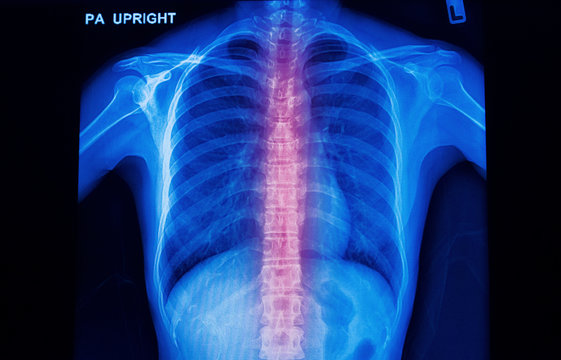 x-ray image of human spinal column  show backl pain