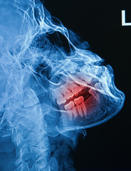 x-ray image of human skull show fracture  mandible
