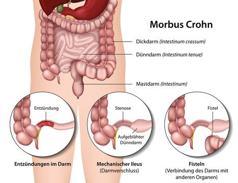 Morbus Crohn, Darmerkrankung Symptome