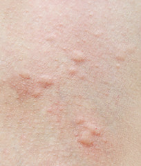 Fototapeta premium Human skin,with an allergic rash.
