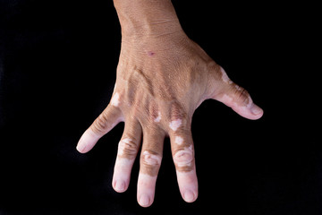 Quadrichrome vitiligo - 63110978