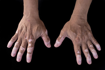 Quadrichrome vitiligo - 63111135