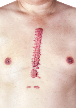 The Hypertrophic Scar Or Swell Cicatrix Is Long, Convex And Large. On The Chest, The Skin Is Pink And Red. Occurs After Surgery. Aortic Dissection Type A By Opening The Chest.