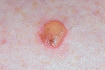 A blister wound on human caucasian skin