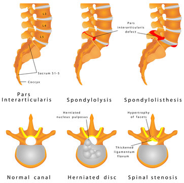 Spine Fracture. Spondylolysis (Spondylolisthesis)