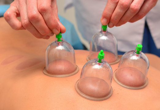 Cupping therapy, woman removes cups from the patient's back