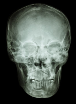 normal human skull