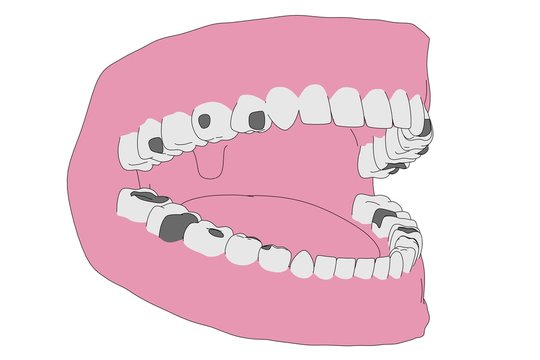 cartoon image of human teeth with fillings