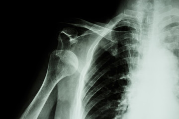 X-ray anterior shoulder dislocation - obrazy, fototapety, plakaty