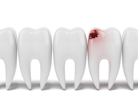 Aching tooth in row of healthy teeth