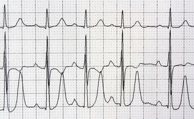 Heart analysis, electrocardiogram graph