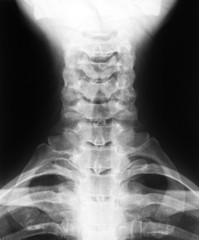 X-ray image of cervical vertebrae