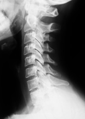 X-ray image of spinal column.side view