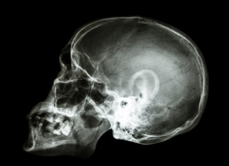 X-ray asian skull