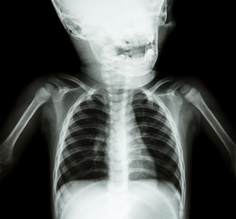 X-ray skull and chest of child