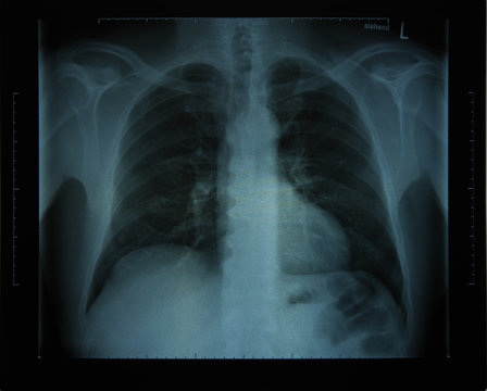 Röntgenbild Oberkörper