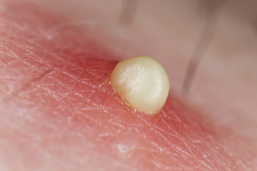 Fototapeta premium Zit ready to pop, extreme close-up