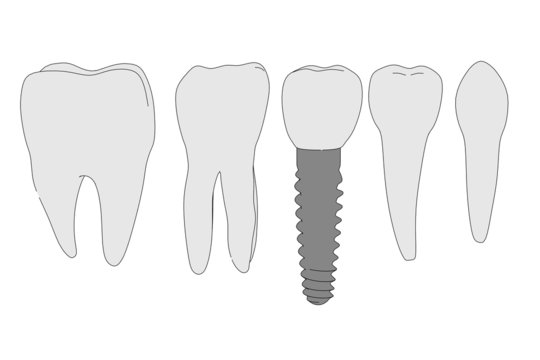 cartoon image of tooth implant