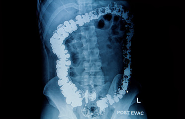 barium enema of a man demonstrated the normal rectum and cecum