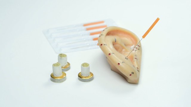 Ohrakupunktur, Modell mit Nadeln und Moxa