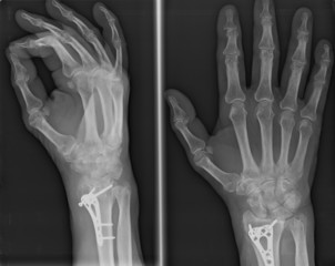 Xray of epiphysial radial fracture reduced