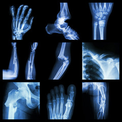Collection of bone fracture