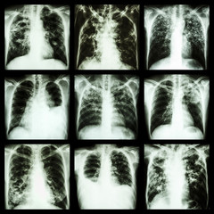 Collection of lung disease