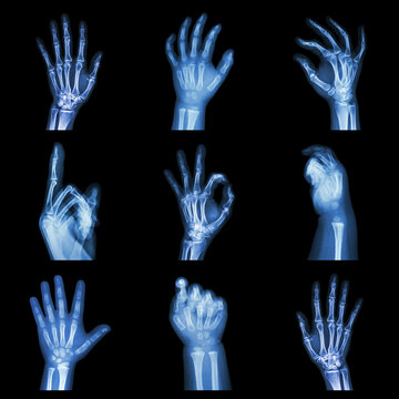Collection x-ray of hands
