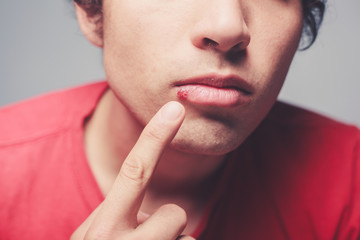 Young man with cold sore - obrazy, fototapety, plakaty
