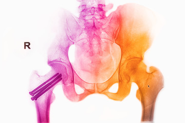 colorful pelvis  x-rays image show fracture head of femur insert