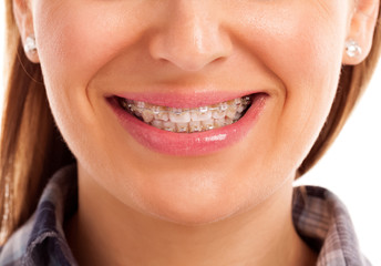 Mouth care teeth with braces