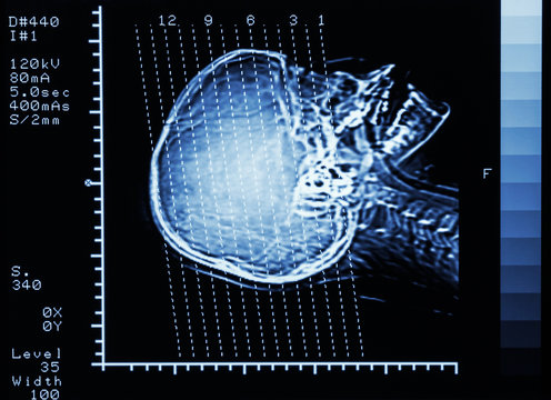 film CT scan (Computed tomography) brain : show section line on