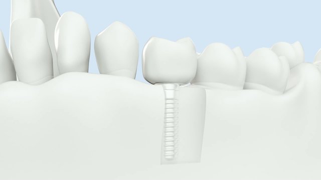 with Alpha / High quality 3D animation showing of dental implant