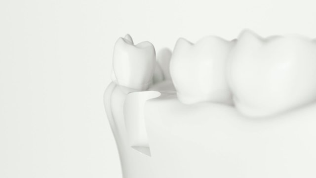 Dental implant  animation with white,black a. alpha