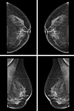Lateral mammogram of female breast