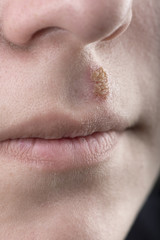 Obraz premium Close up of lips affected by herpes