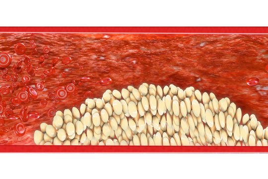 Arteriosklerose - 3D Render