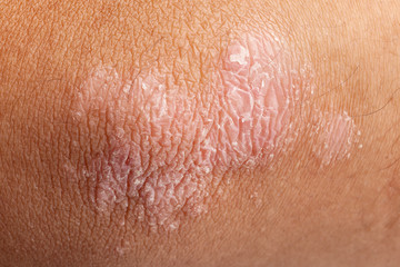 Psoriasis on elbow skin