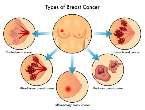tipologie di cancro al seno