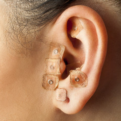Auriculotherapy on human ear.