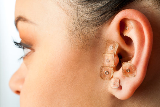 Auriculotherapy on female ear.