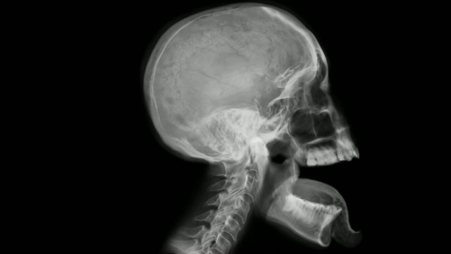 Head x-ray - various moves.