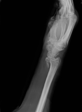 Xray of epiphysial radial fracture reduced