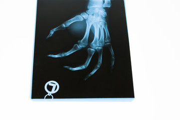 X-ray Left Hand
